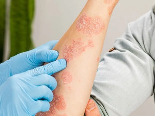 Antifungal Cleansing Use