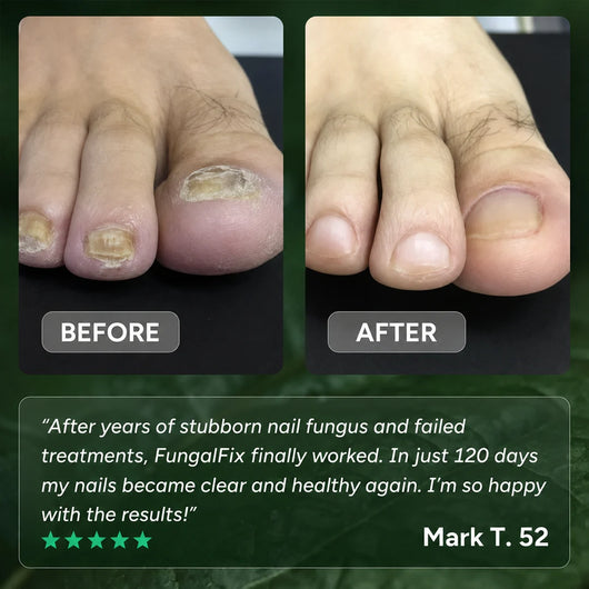 FungalFix™- Nail Fungal Gel