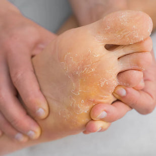 Athlete's Foot